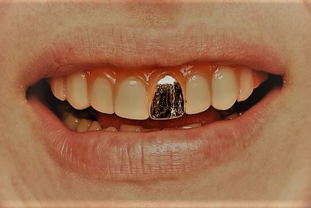 Hrvoje Ivančić: Zlatni&nbsp;zub